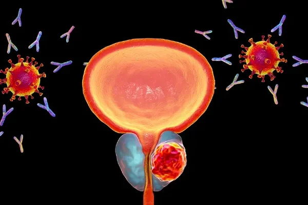 Sasanlimab in NMIBC Potential Impact for Community Oncologists